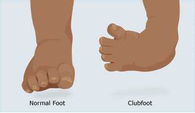 Ctev clubfoot