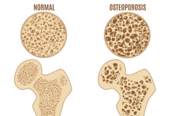 MedbeW osteoporosis bone inline