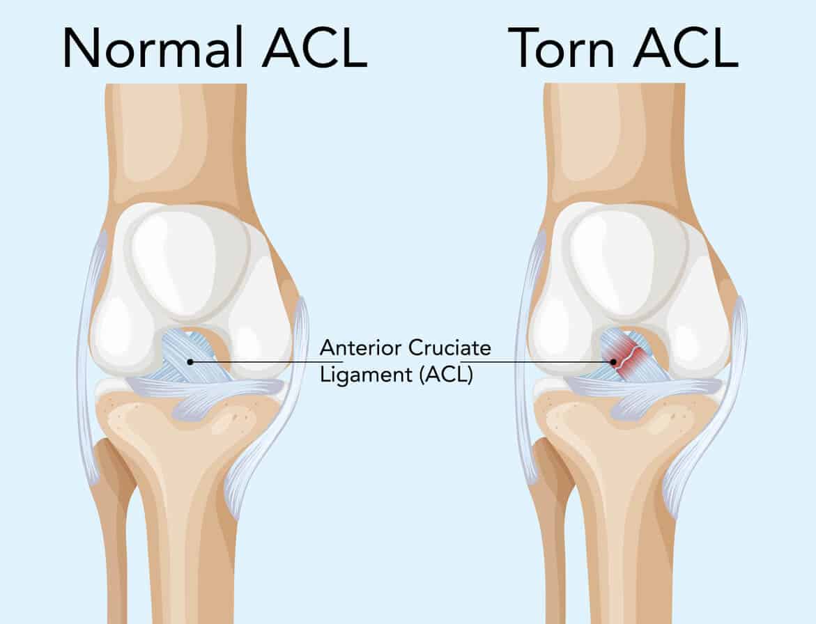 Arthroscopic ACL Reconstruction in Jamshedpur | Dr. Pritpal Singh Saini