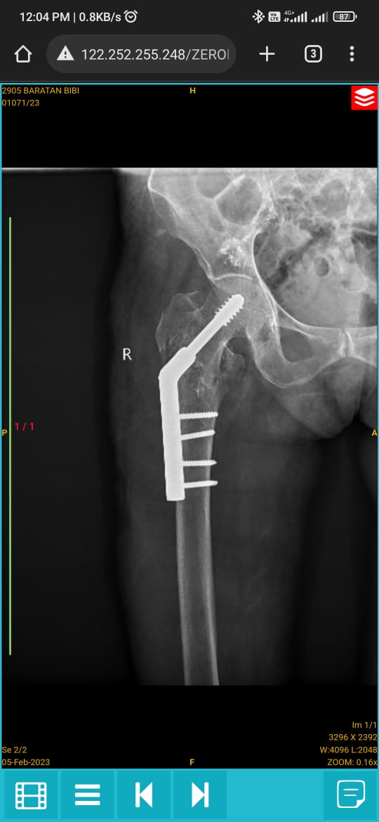 Clinical X-ray showing Dynamic Hip Screw (DHS) fixation for intertrochanteric hip fracture