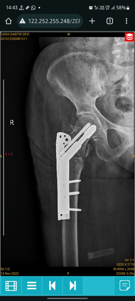Clinical X-ray showing DHS combined with Trochanteric Support Plate (DHS+TSP)