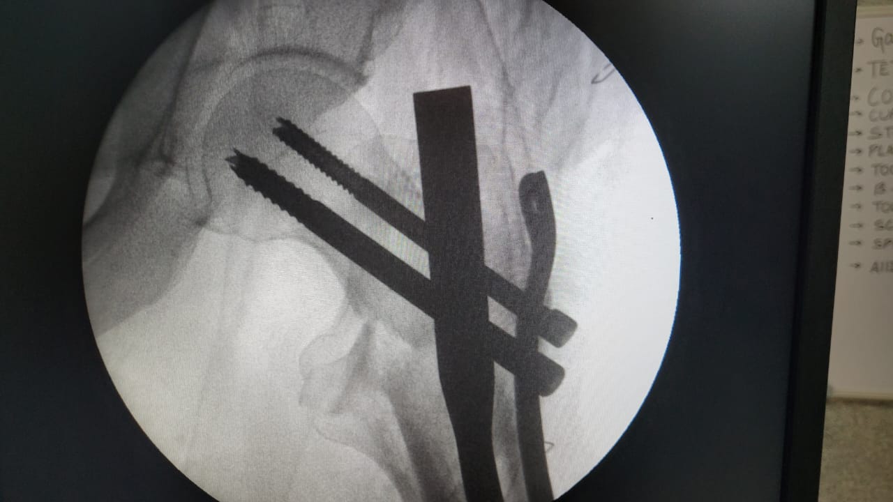 Comprehensive Hip Fracture Treatment: DHS, PFN, Trochanteric Plates & Bipolar Replacement in Jamshedpur | Dr. Pritpal Singh Saini