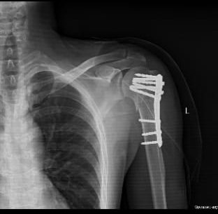 Proximal Humerus Fracture Treatment & Locking Plate Surgery in Jamshedpur | Dr. Pritpal Singh Saini