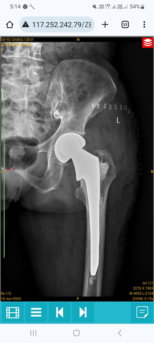 Clinical X-ray showing Bipolar Hemiarthroplasty joint replacement for femoral neck fracture
