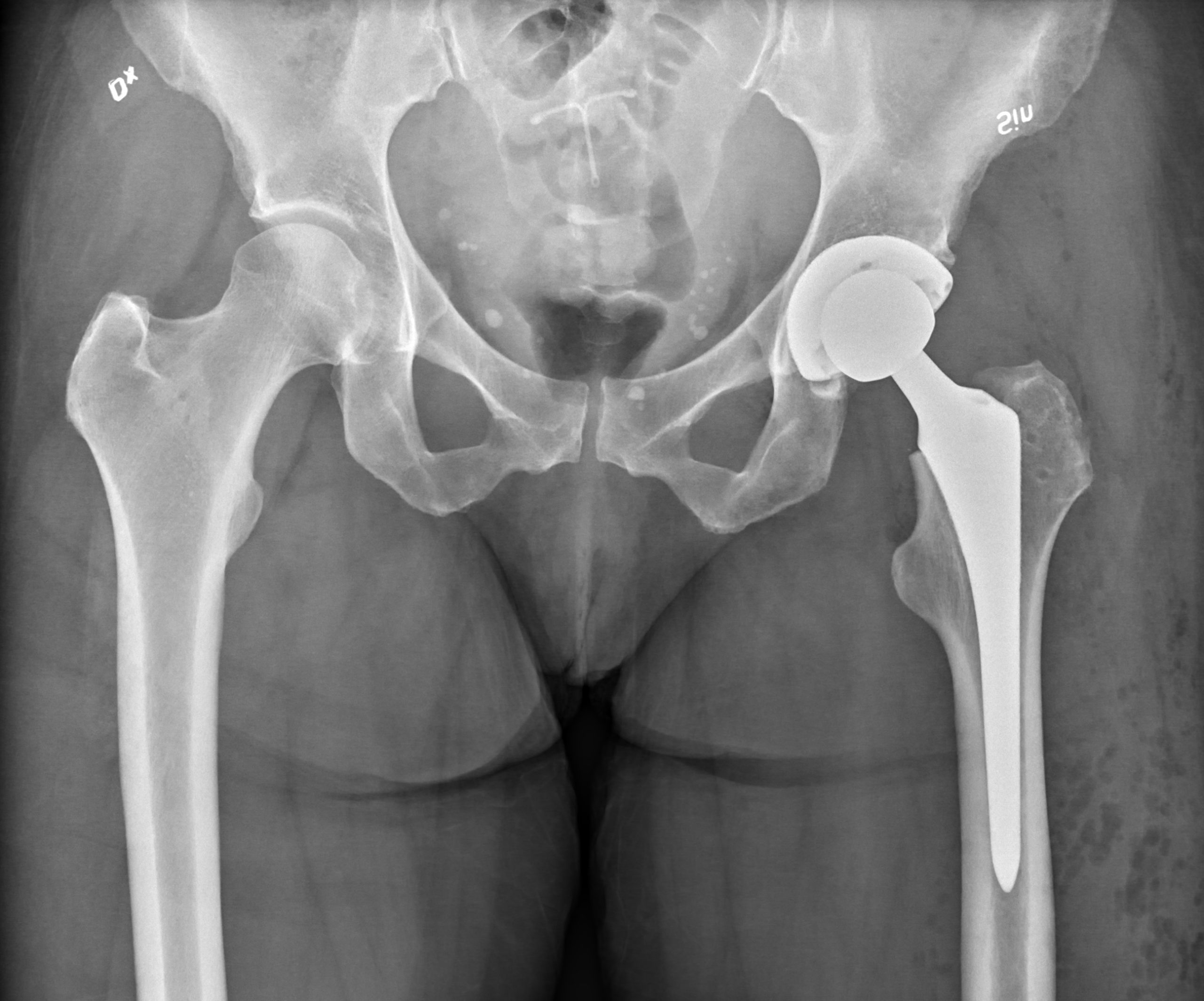 Total Hip Replacement Surgery in Jamshedpur | Dr. Pritpal Singh Saini