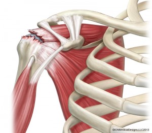 Arthroscopic Rotator Cuff Repair in Jamshedpur | Dr. Pritpal Singh Saini