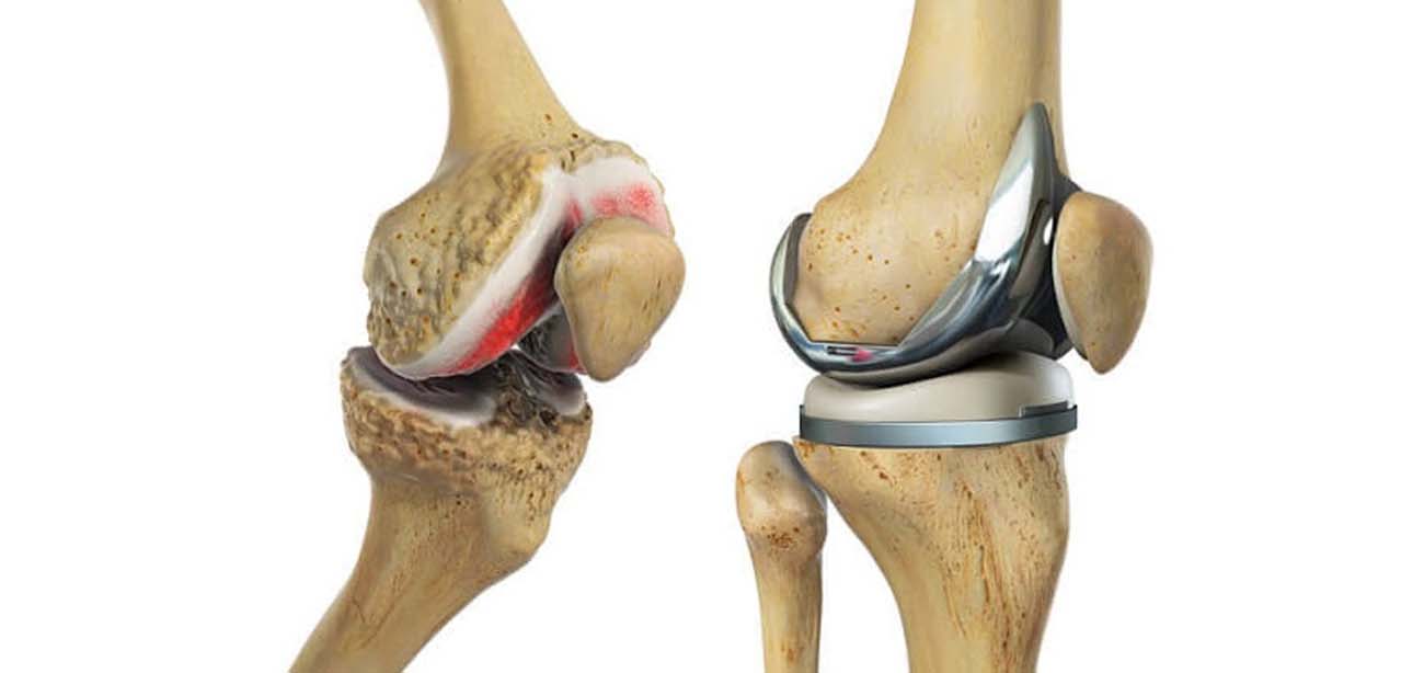 Total Knee Replacement Surgery in Jamshedpur | Dr. Pritpal Singh Saini